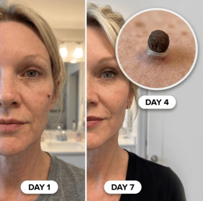 Painless Skin Tag Removal Kit – Glowlyn Products™