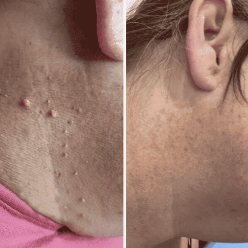 Painless Skin Tag Removal Kit – Glowlyn Products™
