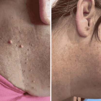 Painless Skin Tag Removal Kit – Glowlyn Products™